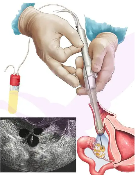 <b>上海做助孕生男孩 上海仁济医院试管费用明细 ‘两个数据孕囊看男女’</b>